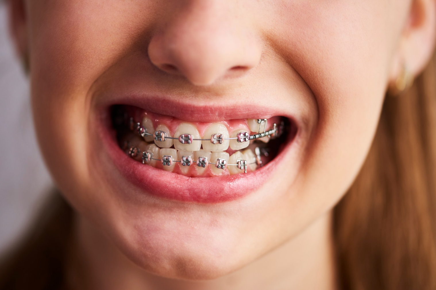 Colori Degli Apparecchi Per I Denti
